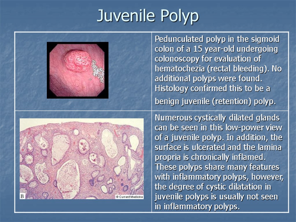 Juvenile Polyp